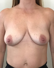 Breast Lift With Implants Before and After | CIARAVINO Plastic Surgery