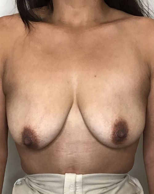 Breast Lift With Implants Before and After | CIARAVINO Plastic Surgery