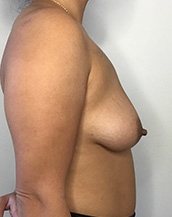 Breast Lift With Implants Before and After | CIARAVINO Plastic Surgery