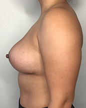 Breast Lift With Implants Before and After | CIARAVINO Plastic Surgery