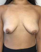 Breast Lift With Implants Before and After | CIARAVINO Plastic Surgery