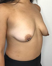 Breast Lift With Implants Before and After | CIARAVINO Plastic Surgery