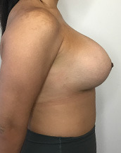 Breast Lift With Implants Before and After | CIARAVINO Plastic Surgery