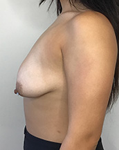 Breast Lift With Implants Before and After | CIARAVINO Plastic Surgery