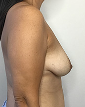 Breast Lift With Implants Before and After | CIARAVINO Plastic Surgery