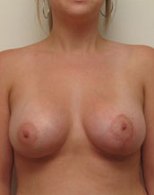 Breast Lift With Implants Before and After | CIARAVINO Plastic Surgery