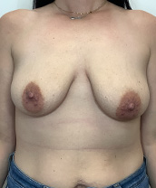 Breast Lift With Implants Before and After | CIARAVINO Plastic Surgery