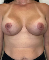 Breast Lift With Implants Before and After | CIARAVINO Plastic Surgery
