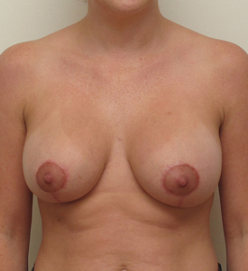 Breast Lift With Implants Before and After | CIARAVINO Plastic Surgery