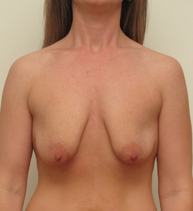 Breast Lift With Implants Before and After | CIARAVINO Plastic Surgery