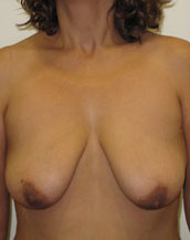 Breast Lift With Implants Before and After | CIARAVINO Plastic Surgery