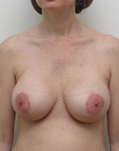 Breast Lift With Implants Before and After | CIARAVINO Plastic Surgery