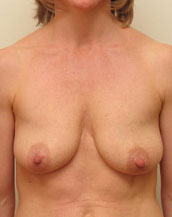 Breast Lift With Implants Before and After | CIARAVINO Plastic Surgery