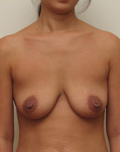 Breast Lift With Implants Before and After | CIARAVINO Plastic Surgery