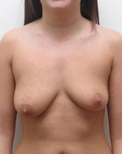 Breast Lift With Implants Before and After | CIARAVINO Plastic Surgery