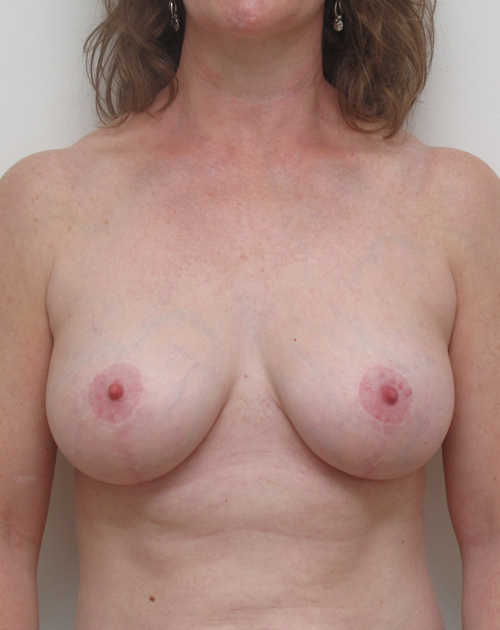 Breast Lift With Implants Before and After | CIARAVINO Plastic Surgery