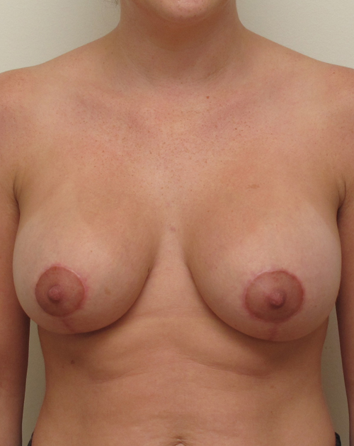 Breast Lift With Implants Before and After | CIARAVINO Plastic Surgery