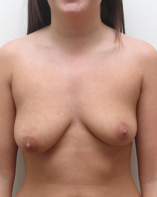 Breast Lift With Implants Before and After | CIARAVINO Plastic Surgery