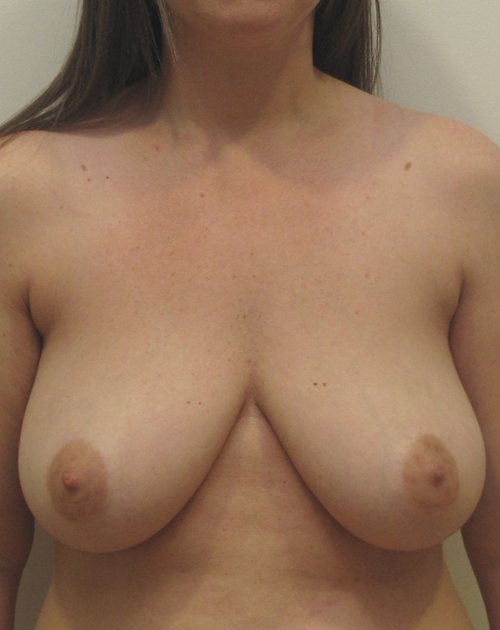 Breast Lift With Implants Before and After | CIARAVINO Plastic Surgery