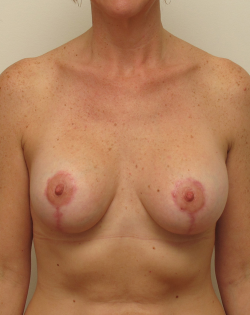 Breast Lift With Implants Before and After | CIARAVINO Plastic Surgery