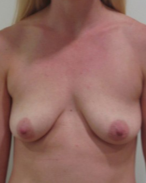 Breast Lift With Implants Before and After | CIARAVINO Plastic Surgery