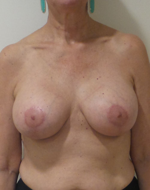 Breast Lift With Implants Before and After | CIARAVINO Plastic Surgery