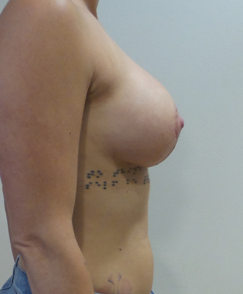 Breast Lift With Implants Before and After | CIARAVINO Plastic Surgery