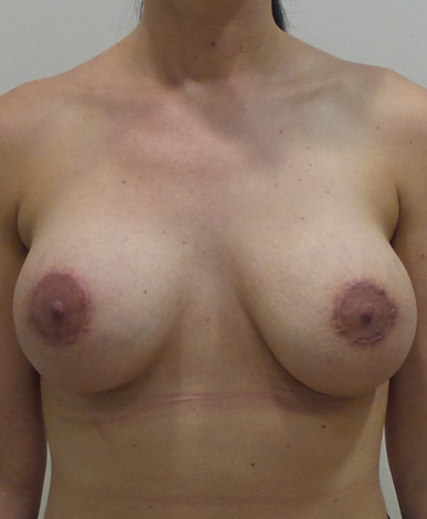 Breast Lift With Implants Before and After | CIARAVINO Plastic Surgery