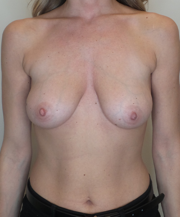 Breast Lift With Implants Before and After | CIARAVINO Plastic Surgery