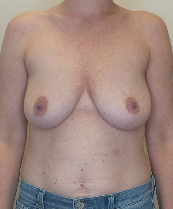 Breast Lift With Implants Before and After | CIARAVINO Plastic Surgery