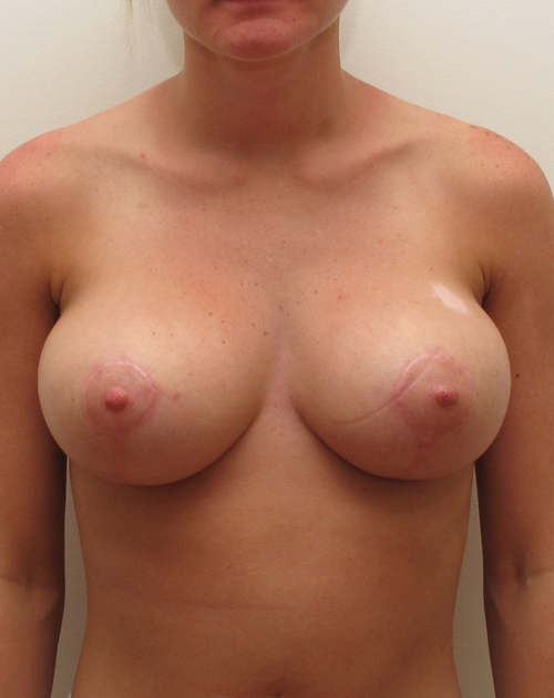 Breast Reduction Before and After | CIARAVINO Plastic Surgery