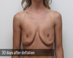 Percutaneous Implant Deflation Before and After | CIARAVINO Plastic Surgery