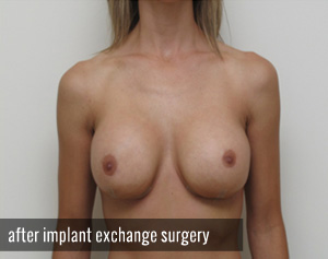 Percutaneous Implant Deflation Before and After | CIARAVINO Plastic Surgery