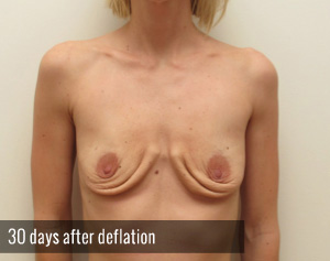 Percutaneous Implant Deflation Before and After | CIARAVINO Plastic Surgery