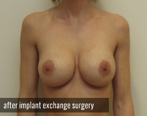 Percutaneous Implant Deflation Before and After | CIARAVINO Plastic Surgery