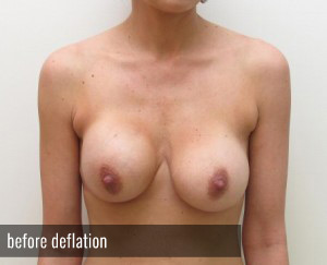 Percutaneous Implant Deflation Before and After | CIARAVINO Plastic Surgery