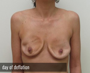 Percutaneous Implant Deflation Before and After | CIARAVINO Plastic Surgery