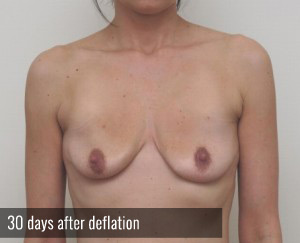 Percutaneous Implant Deflation Before and After | CIARAVINO Plastic Surgery