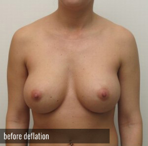 Percutaneous Implant Deflation Before and After | CIARAVINO Plastic Surgery