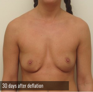 Percutaneous Implant Deflation Before and After | CIARAVINO Plastic Surgery