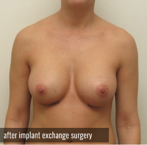 Percutaneous Implant Deflation Before and After | CIARAVINO Plastic Surgery