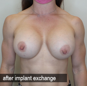 Percutaneous Implant Deflation Before and After | CIARAVINO Plastic Surgery