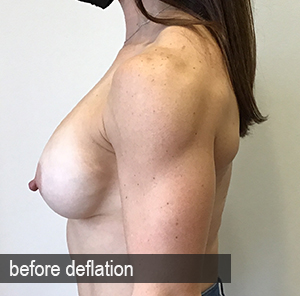 Percutaneous Implant Deflation Before and After | CIARAVINO Plastic Surgery