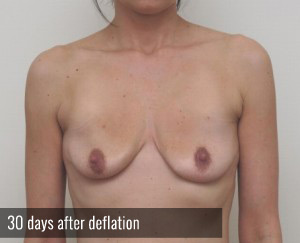 Percutaneous Implant Deflation Before and After | CIARAVINO Plastic Surgery & Med Spa