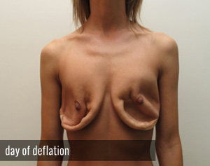 Percutaneous Implant Deflation Before and After | CIARAVINO Plastic Surgery & Med Spa