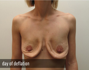 Percutaneous Implant Deflation Before and After | CIARAVINO Plastic Surgery & Med Spa