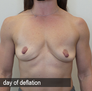 Percutaneous Implant Deflation Before and After | CIARAVINO Plastic Surgery & Med Spa