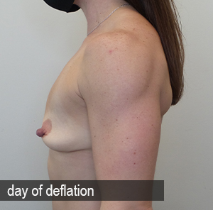 Percutaneous Implant Deflation Before and After | CIARAVINO Plastic Surgery & Med Spa