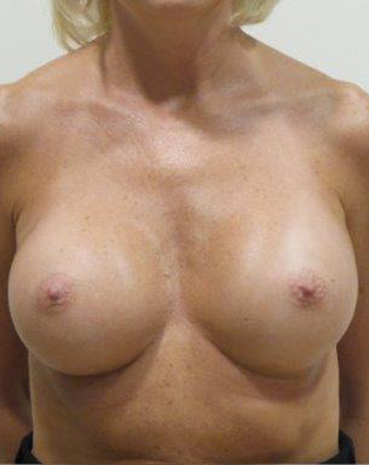 Ultra High Profile Silicone Implants Before and After | CIARAVINO Plastic Surgery & Med Spa