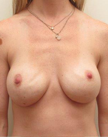 Ultra High Profile Silicone Implants Before and After | CIARAVINO Plastic Surgery & Med Spa